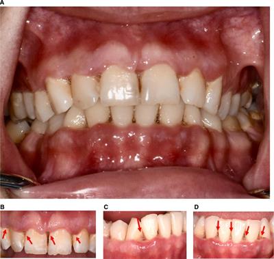 Necrotizing periodontal disease in a nutritionally deficient patient: A case report
